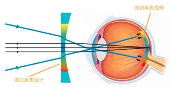 全效型离焦技术示意图